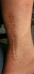 5 months after tendon repair; no scar treatment to date keloid is beginning to from