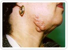 Keloid scar prior to surgical removal