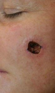 Resulting wound from basal cell carcinoma removal via Mohs technique