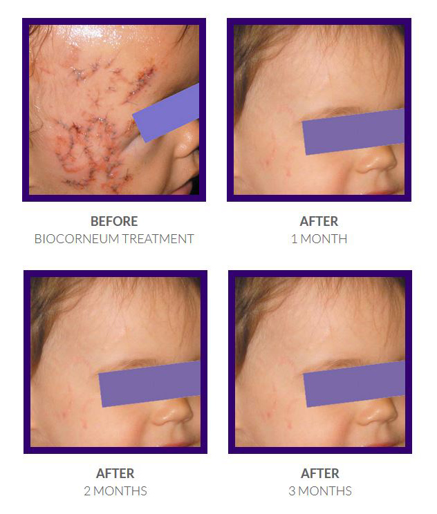 What is the best scar treatment