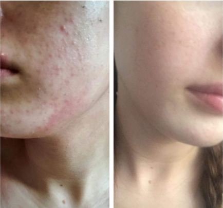 PuriDerma cream on acne scars
