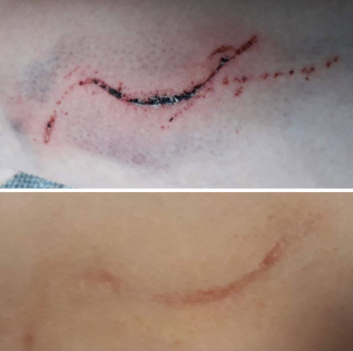 PuriDerma on a c-section scar