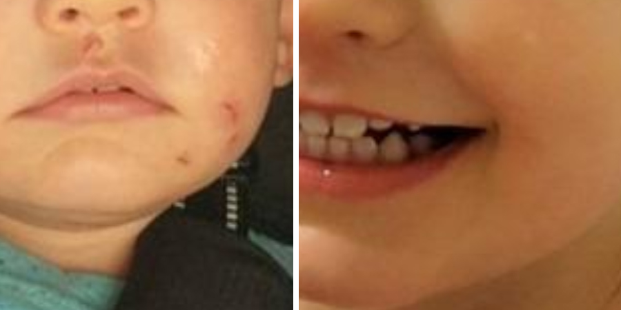 Mederma Kids face scar improvement